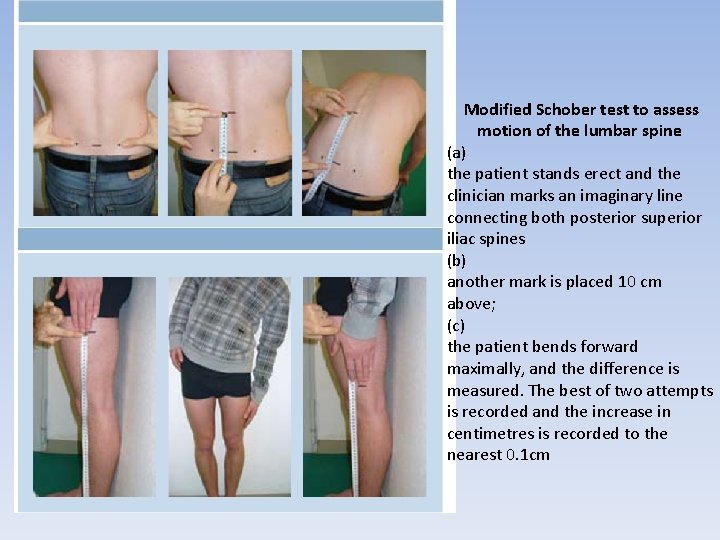 Modified Schober test to assess motion of the lumbar spine (a) the patient stands