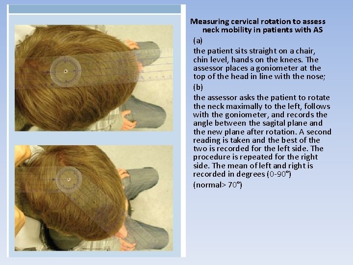  • • • Measuring cervical rotation to assess neck mobility in patients with