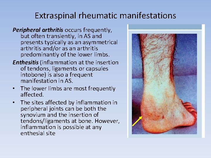 Extraspinal rheumatic manifestations Peripheral arthritis occurs frequently, but often transiently, in AS and presents