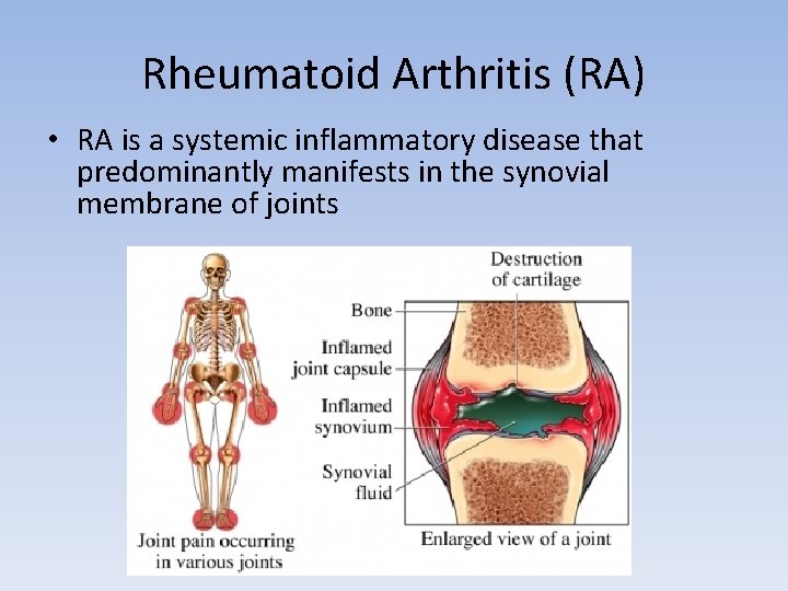 Rheumatoid Arthritis (RA) • RA is a systemic inflammatory disease that predominantly manifests in