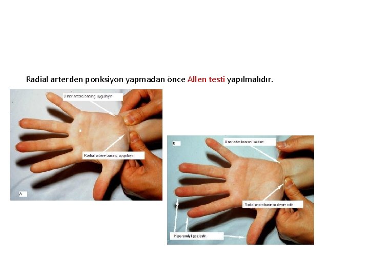 Radial arterden ponksiyon yapmadan önce Allen testi yapılmalıdır. 