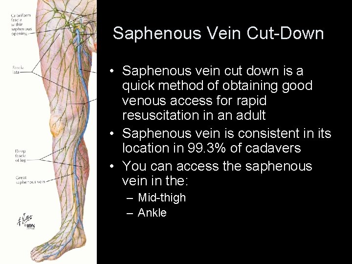 Saphenous Vein Cut-Down • Saphenous vein cut down is a quick method of obtaining