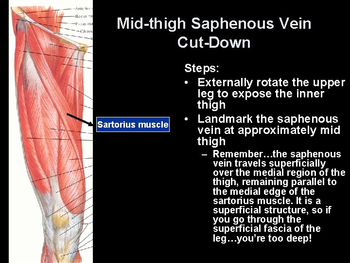 Mid-thigh Saphenous Vein Cut-Down Sartorius muscle Steps: • Externally rotate the upper leg to