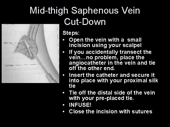 Mid-thigh Saphenous Vein Cut-Down Steps: • Open the vein with a small incision using