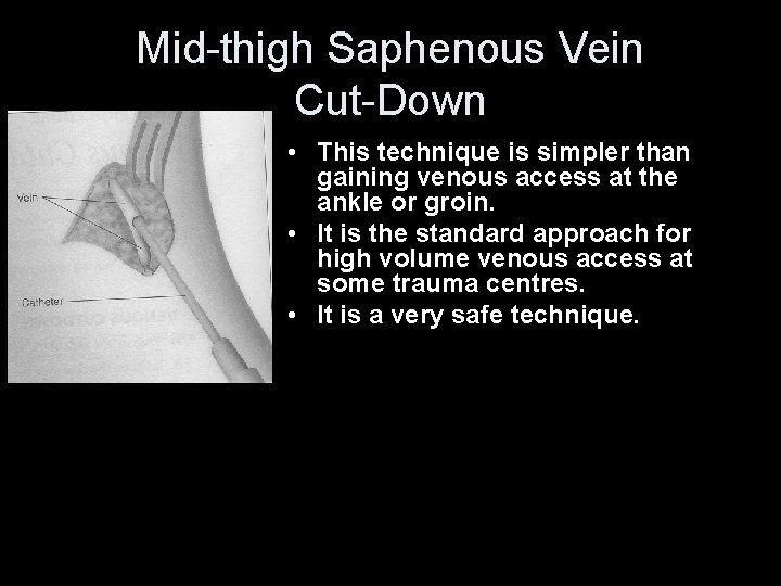 Mid-thigh Saphenous Vein Cut-Down • This technique is simpler than gaining venous access at