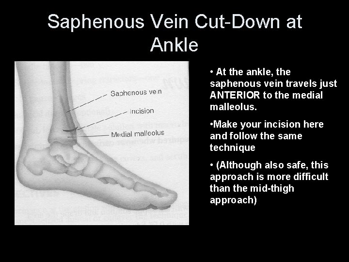Saphenous Vein Cut-Down at Ankle • At the ankle, the saphenous vein travels just
