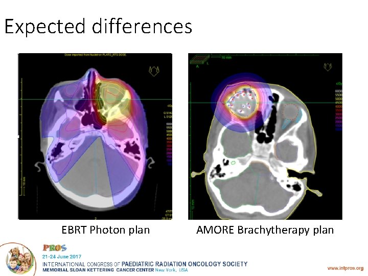 Expected differences EBRT Photon plan AMORE Brachytherapy plan 