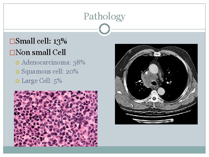 Pathology �Small cell: 13% �Non small Cell Adenocarcinoma: 38% Squamous cell: 20% Large Cell: