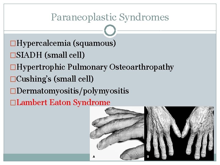 Paraneoplastic Syndromes �Hypercalcemia (squamous) �SIADH (small cell) �Hypertrophic Pulmonary Osteoarthropathy �Cushing’s (small cell) �Dermatomyositis/polymyositis