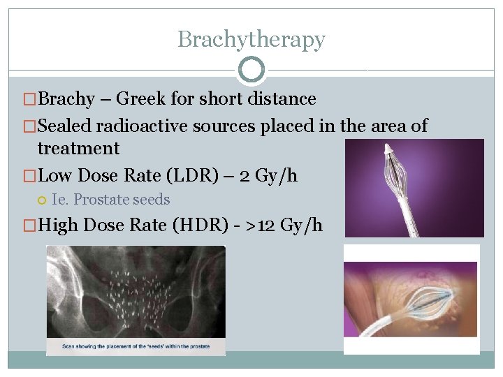 Brachytherapy �Brachy – Greek for short distance �Sealed radioactive sources placed in the area