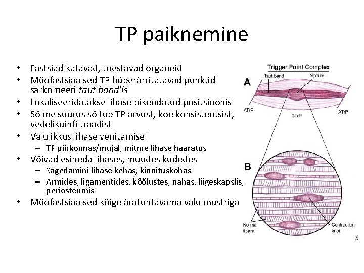 TP paiknemine • Fastsiad katavad, toestavad organeid • Müofastsiaalsed TP hüperärritatavad punktid sarkomeeri taut