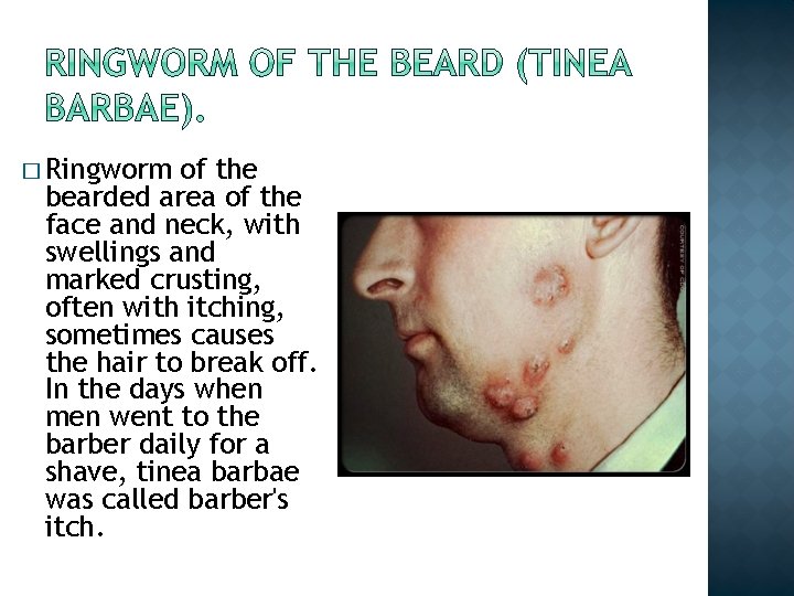 � Ringworm of the bearded area of the face and neck, with swellings and � Ringworm of the bearded area of the face and neck, with swellings and
