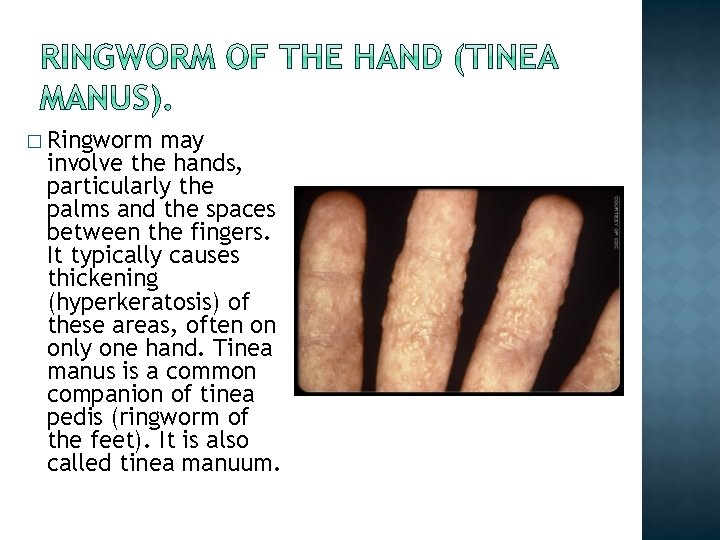 � Ringworm may involve the hands, particularly the palms and the spaces between the � Ringworm may involve the hands, particularly the palms and the spaces between the