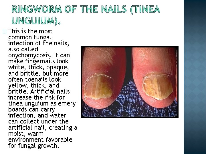 � This is the most common fungal infection of the nails, also called onychomycosis. � This is the most common fungal infection of the nails, also called onychomycosis.