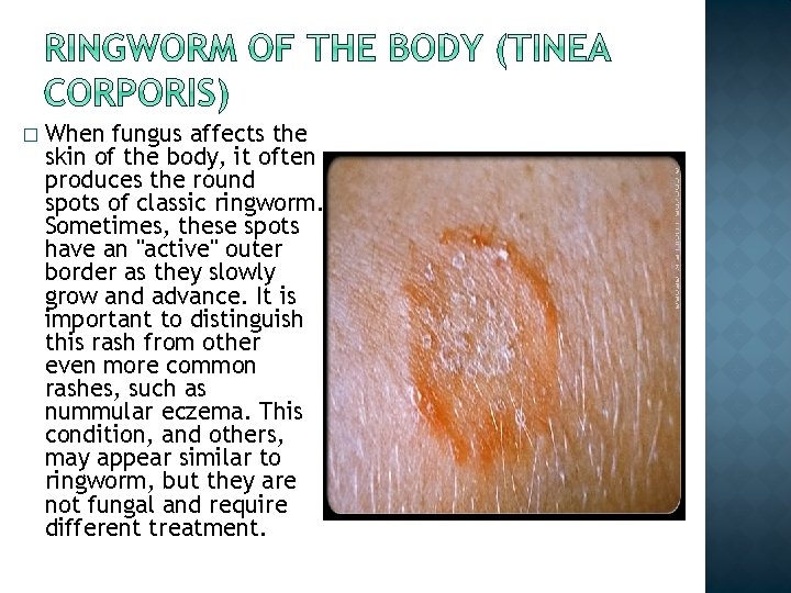 � When fungus affects the skin of the body, it often produces the round � When fungus affects the skin of the body, it often produces the round
