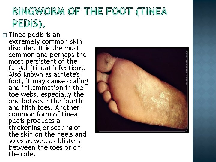 � Tinea pedis is an extremely common skin disorder. It is the most common � Tinea pedis is an extremely common skin disorder. It is the most common