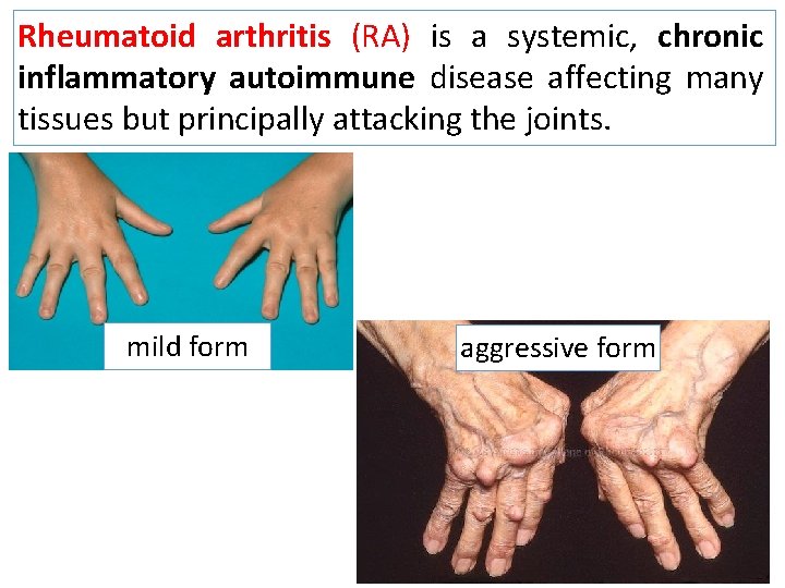 Rheumatoid arthritis (RA) is a systemic, chronic inflammatory autoimmune disease affecting many tissues but