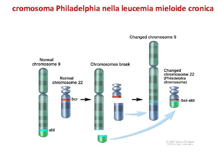 Il cromosoma Philadelphia nella leucemia mieloide cronica Il gene di fusione ABL-BCR produce una