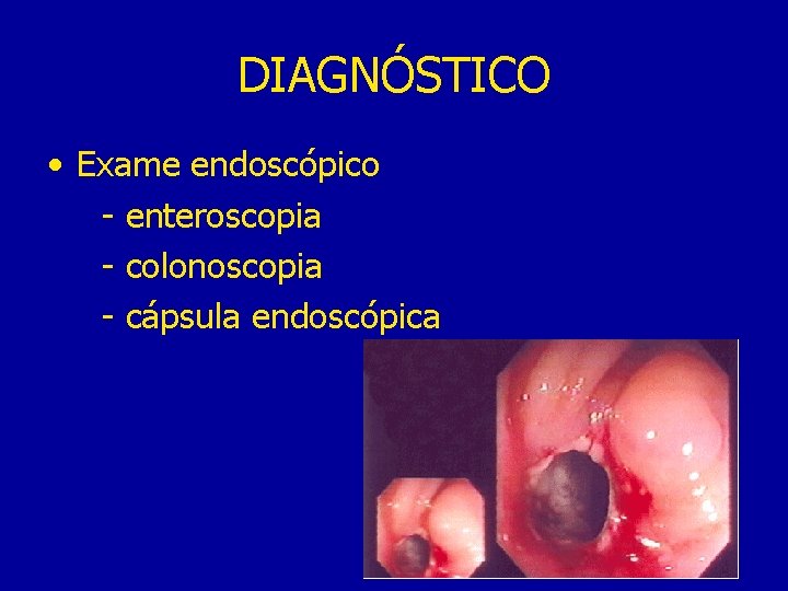 DIAGNÓSTICO • Exame endoscópico - enteroscopia - colonoscopia - cápsula endoscópica 