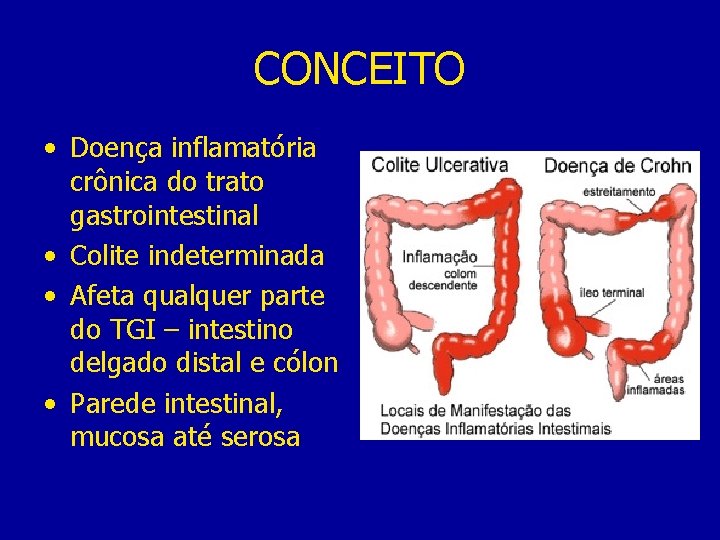 CONCEITO • Doença inflamatória crônica do trato gastrointestinal • Colite indeterminada • Afeta qualquer