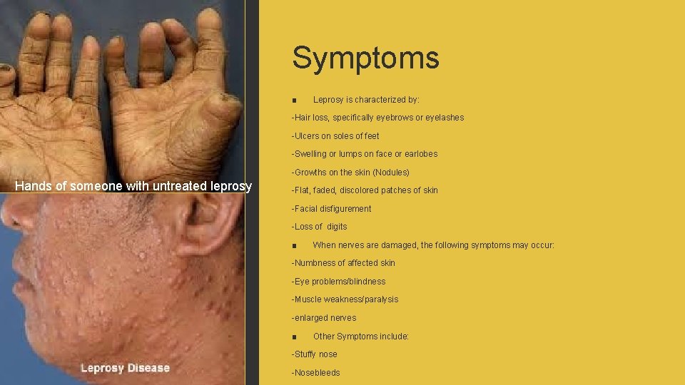 Symptoms ■ Leprosy is characterized by: -Hair loss, specifically eyebrows or eyelashes -Ulcers on