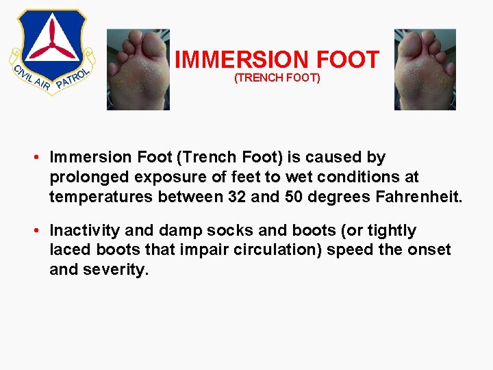 IMMERSION FOOT (TRENCH FOOT) • Immersion Foot (Trench Foot) is caused by prolonged exposure IMMERSION FOOT (TRENCH FOOT) • Immersion Foot (Trench Foot) is caused by prolonged exposure