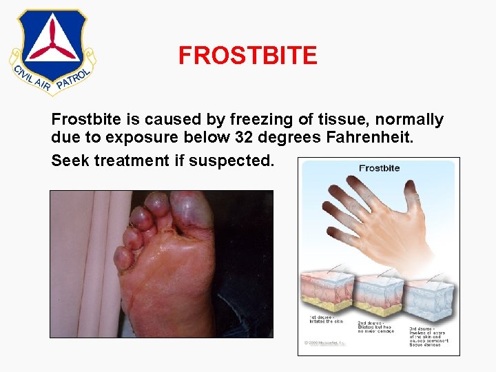 FROSTBITE Frostbite is caused by freezing of tissue, normally due to exposure below 32 FROSTBITE Frostbite is caused by freezing of tissue, normally due to exposure below 32
