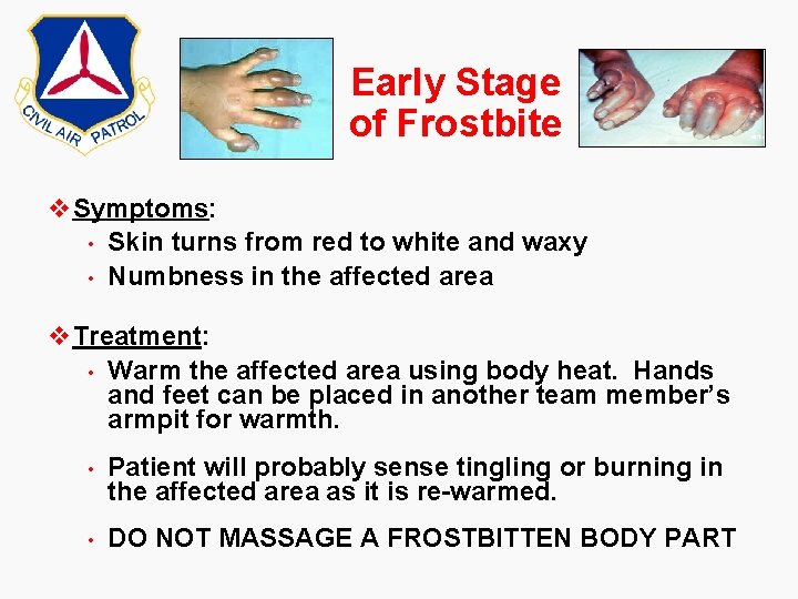 Early Stage of Frostbite v. Symptoms: • Skin turns from red to white and Early Stage of Frostbite v. Symptoms: • Skin turns from red to white and
