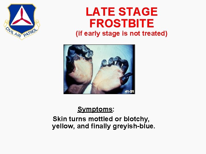 LATE STAGE FROSTBITE (if early stage is not treated) Symptoms: Skin turns mottled or LATE STAGE FROSTBITE (if early stage is not treated) Symptoms: Skin turns mottled or