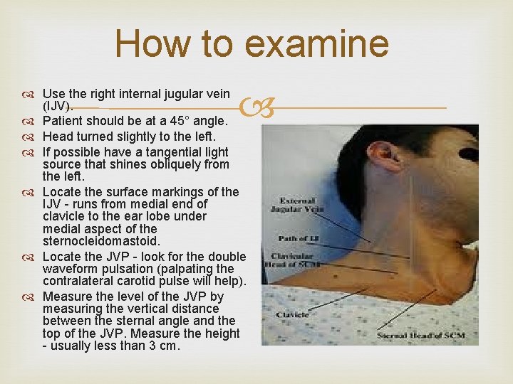 How to examine Use the right internal jugular vein (IJV). Patient should be at