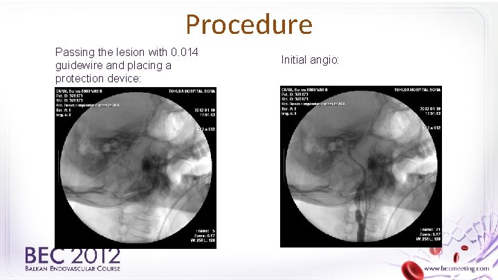 Procedure Passing the lesion with 0. 014 guidewire and placing a protection device: Initial