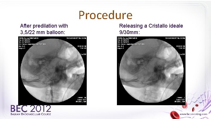 Procedure After predilation with 3, 5/22 mm balloon: Releasing a Cristallo ideale 9/30 mm: