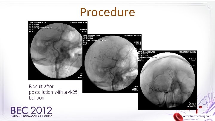 Procedure Result after postdilation with a 4/25 balloon 