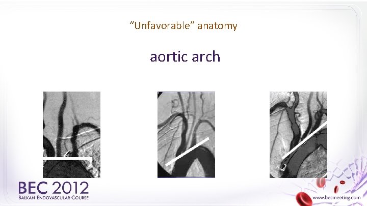 “Unfavorable” anatomy aortic arch 