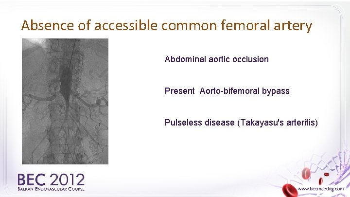 Absence of accessible common femoral artery Abdominal aortic occlusion Present Aorto-bifemoral bypass Pulseless disease