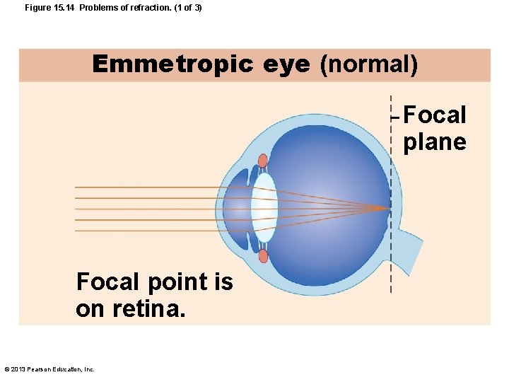 Figure 15. 14 Problems of refraction. (1 of 3) Emmetropic eye (normal) Focal plane