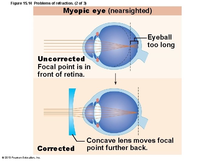 Figure 15. 14 Problems of refraction. (2 of 3) Myopic eye (nearsighted) Eyeball too