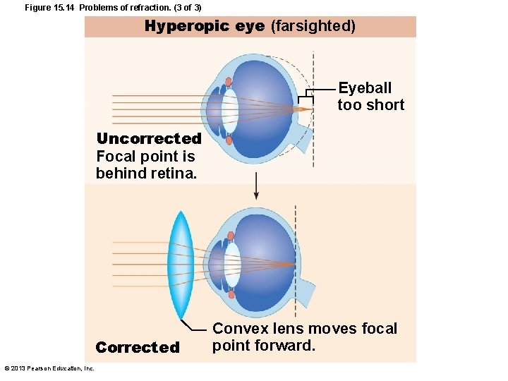 Figure 15. 14 Problems of refraction. (3 of 3) Hyperopic eye (farsighted) Eyeball too