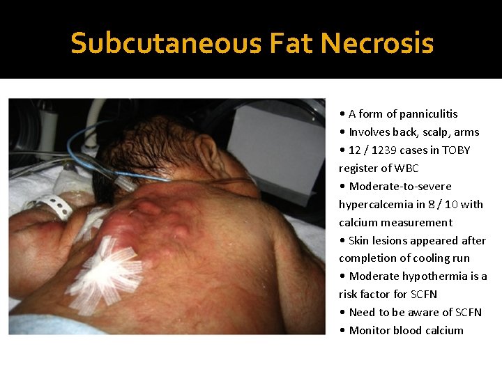 Subcutaneous Fat Necrosis • A form of panniculitis • Involves back, scalp, arms •