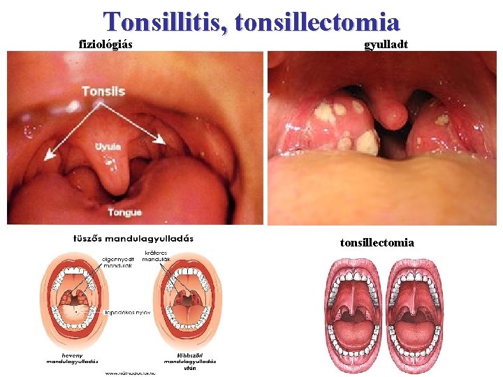 Tonsillitis, tonsillectomia fiziológiás gyulladt tonsillectomia 