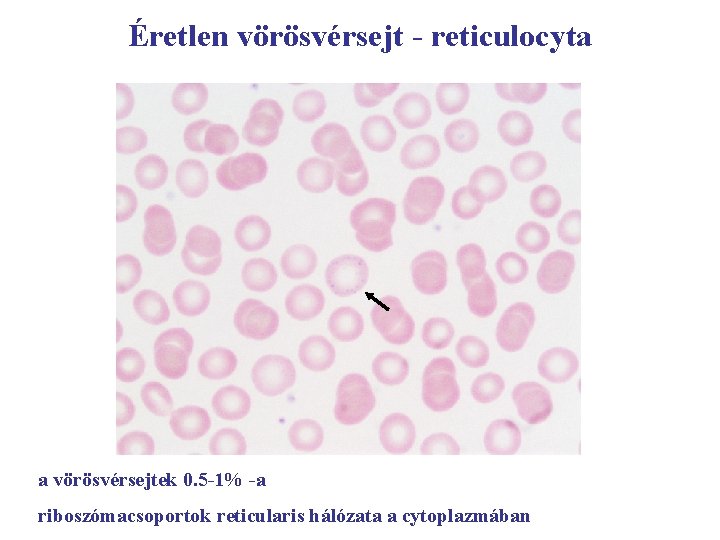 Éretlen vörösvérsejt - reticulocyta a vörösvérsejtek 0. 5 -1% -a riboszómacsoportok reticularis hálózata a