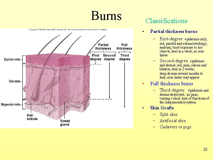 Burns Classifications • Partial thickness burns – First-degree: epidermis only; red, painful and edema(swelling);