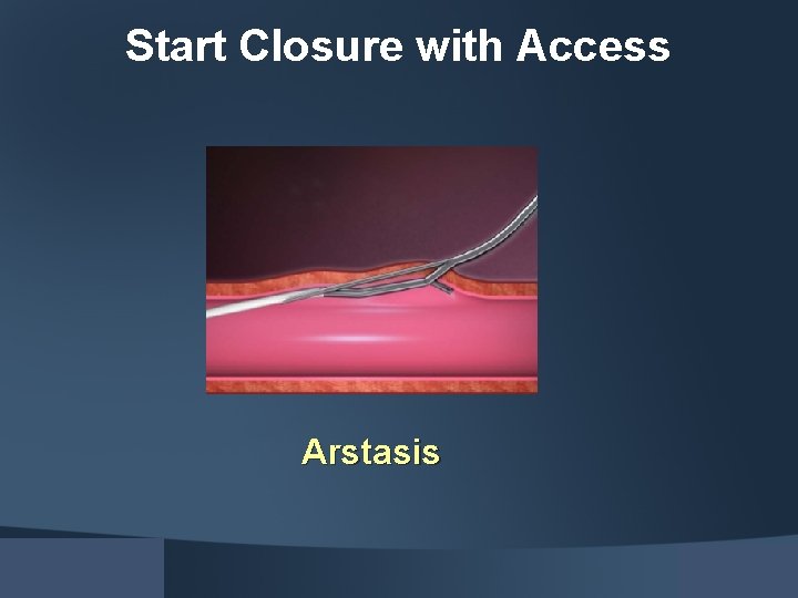 Start Closure with Access Arstasis 