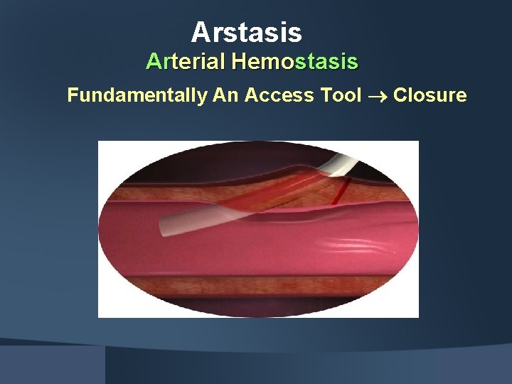 Arstasis Arterial Hemostasis Fundamentally An Access Tool Closure 