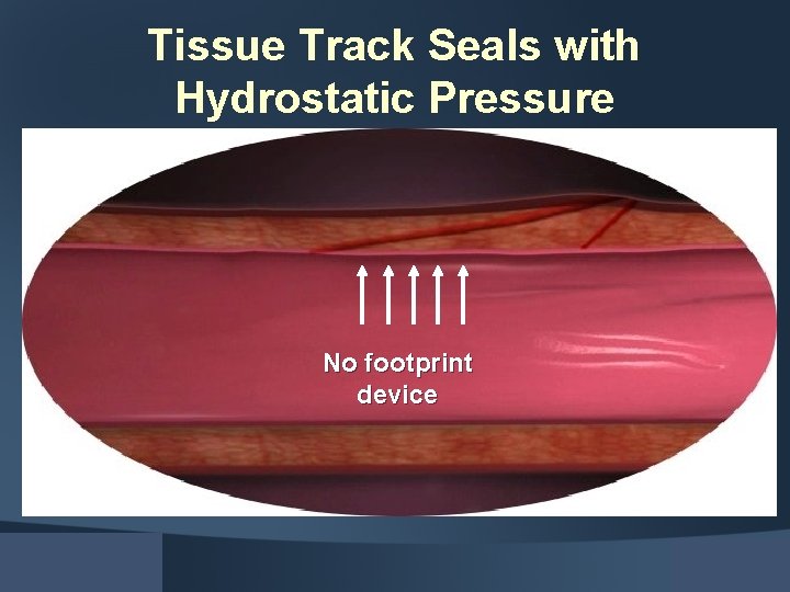 Tissue Track Seals with Hydrostatic Pressure No footprint device 