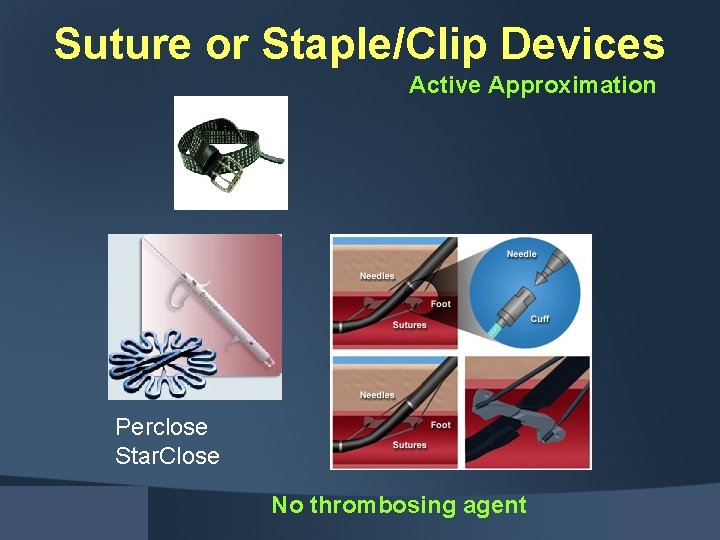 Suture or Staple/Clip Devices Active Approximation Perclose Star. Close No thrombosing agent 