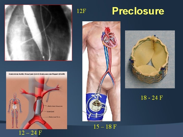 12 F Preclosure 18 - 24 F 12 – 24 F 15 – 18