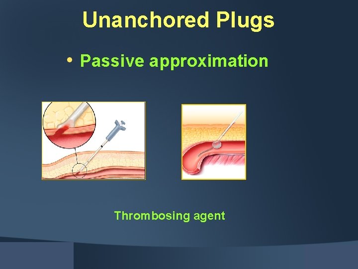 Unanchored Plugs • Passive approximation Thrombosing agent 