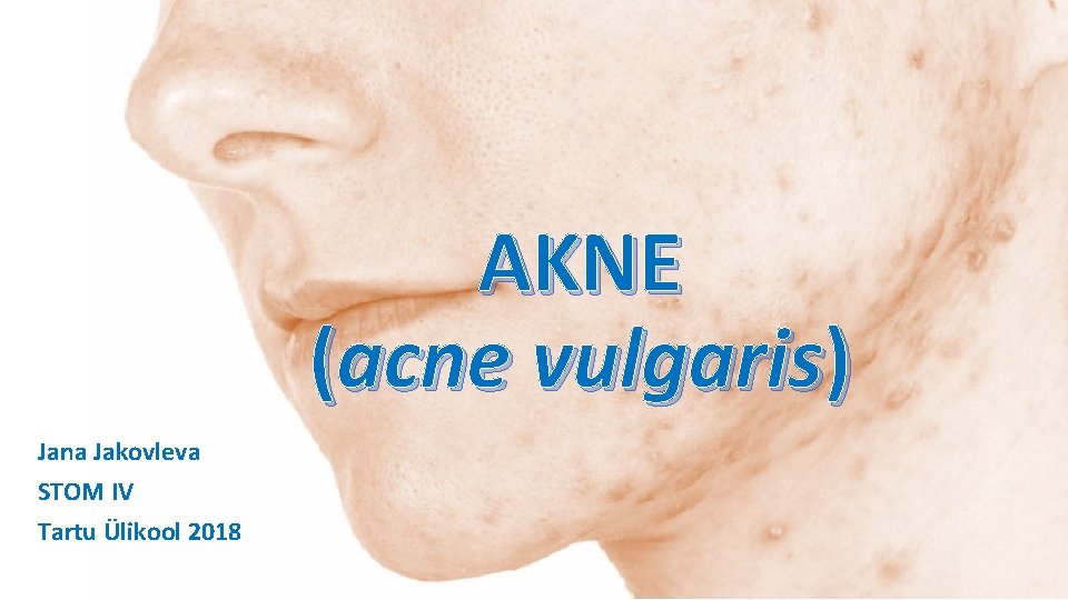 AKNE (acne vulgaris) Jana Jakovleva STOM IV Tartu Ülikool 2018 