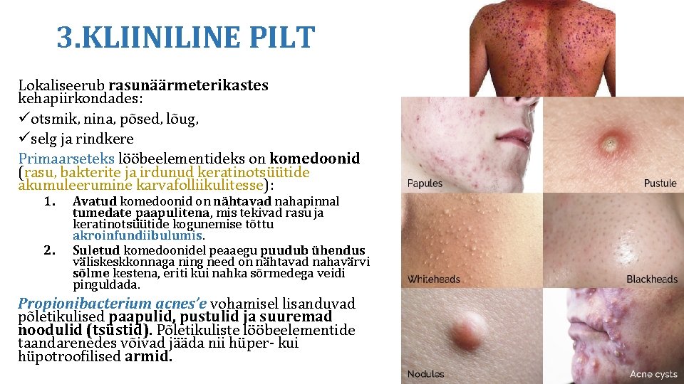 3. KLIINILINE PILT Lokaliseerub rasunäärmeterikastes kehapiirkondades: üotsmik, nina, põsed, lõug, üselg ja rindkere Primaarseteks